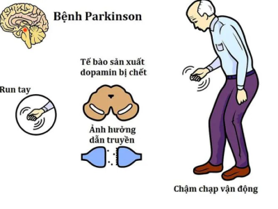 BỆNH PARKINSON LÀ GÌ